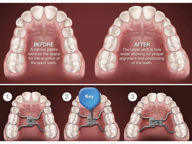 تنگی فک بالا