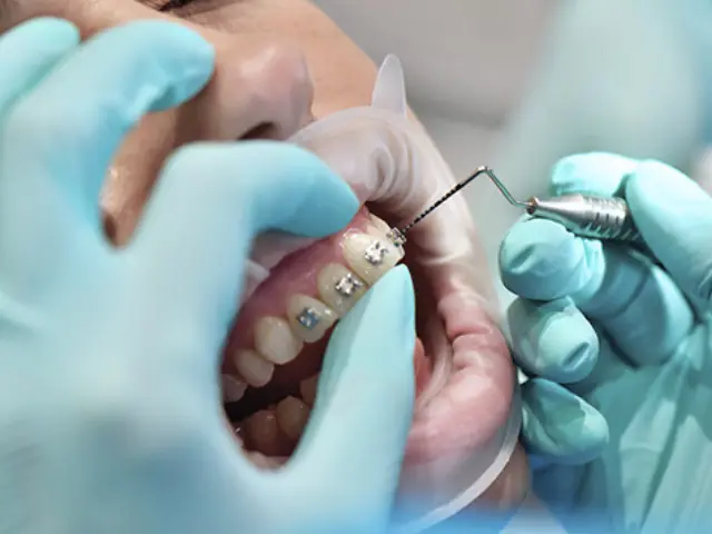 روش چسباندن براکت ها