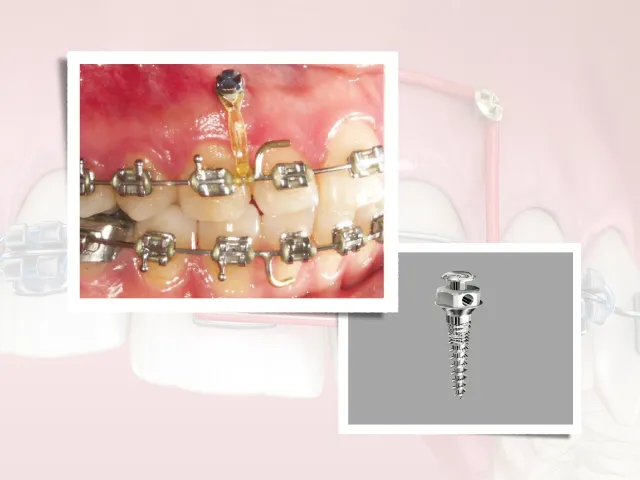 سوالات متداول  مینی اسکرو