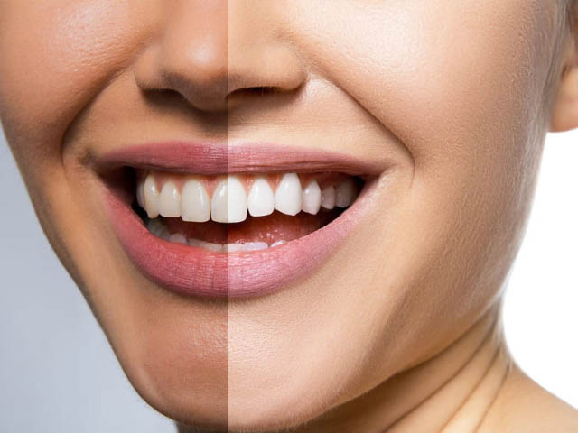 کشهای کوچک و آبی رنگ ارتودنسی بین دندونها (سپریتور) چیه؟