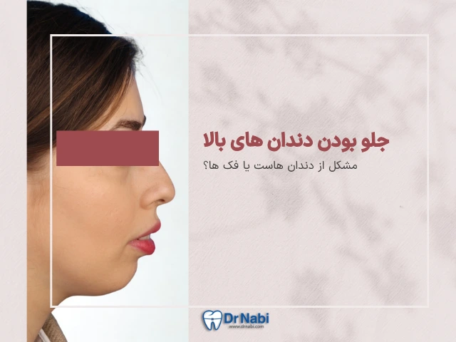 درمان جلو بودن دندان های بالا - آیا با ارتودنسی اصلاح میشود؟