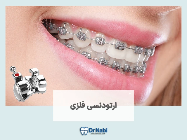 ارتودنسی فلزی چیست؟ مزایا، معایب، قیمت و مدت درمان در 1405