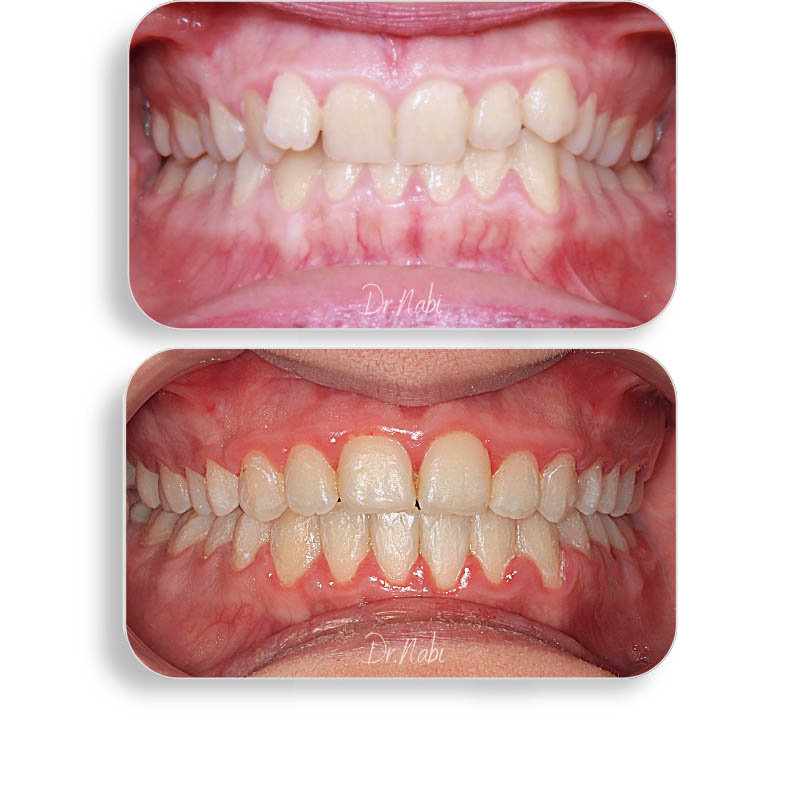 نما داخل دهان قبل درمان بیمار دیپ بایت و نما داخل دهان بعد درمان با ارتودنسی ثابت توسط دکتر نبی در یک تصویر