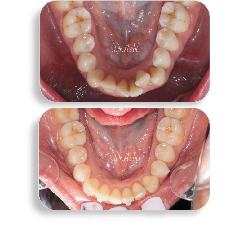 نما داخل دهان بیمار با نامرتبی شدید دندانها قبل درمان و نما داخل دهان بعد درمان با ارتودنسی نامرئی توسط دکتر نبی در یک تصویر