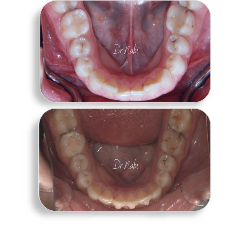 نما داخل دهان بیمار با دیپ بایت و نامرتبی دندانها قبل درمان و نما داخل دهان بعد درمان با ارتودنسی شفاف توسط دکتر نبی در یک تصویر