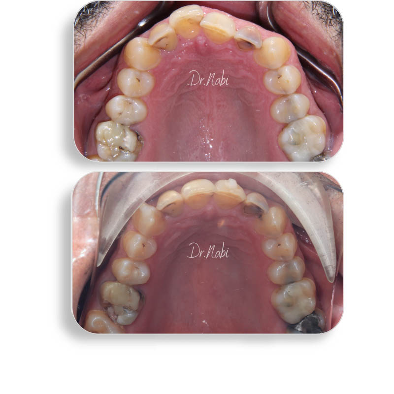 نما داخل دهان بیمار با نامرتبی دندانها و دیپ بایت متوسط  قبل درمان و نما داخل دهان بعد درمان با ارتودنسی نامرئی توسط دکتر نبی در یک تصویر