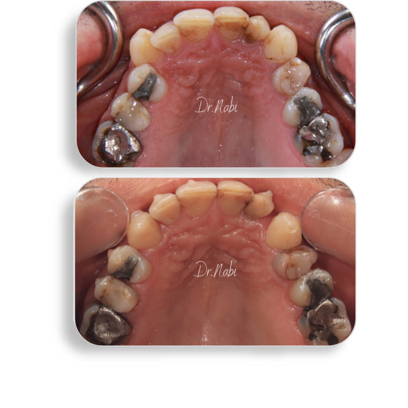 نما داخل دهان بیمار با دندان کانین خارج از قوس و عدم تقارن سایز لترال ها قبل درمان و نما داخل دهان بعد درمان با ارتودنسی نامرئی توسط دکتر نبی در یک تصویر