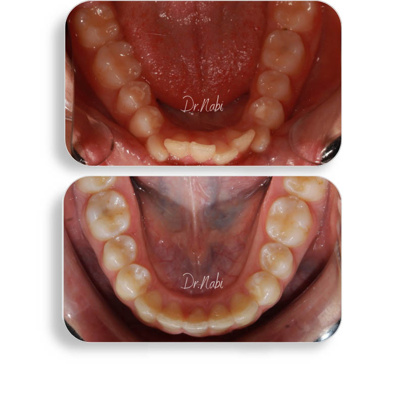 نما داخل دهان با نامرتبی دندانها و مشکل سیزوربایت قبل درمان و نما داخل دهان بعد درمان با ارتودنسی نامرئی توسط دکتر نبی در یک تصویر