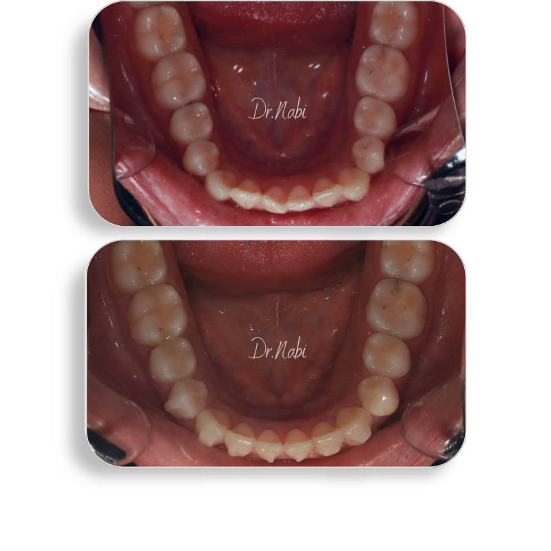 نما داخل دهان بیمار با نامرتبی دندانها واپن بایت خفیف  قبل درمان و نما داخل دهان بعد درمان با ارتودنسی نامرئی توسط دکتر نبی در یک تصویر