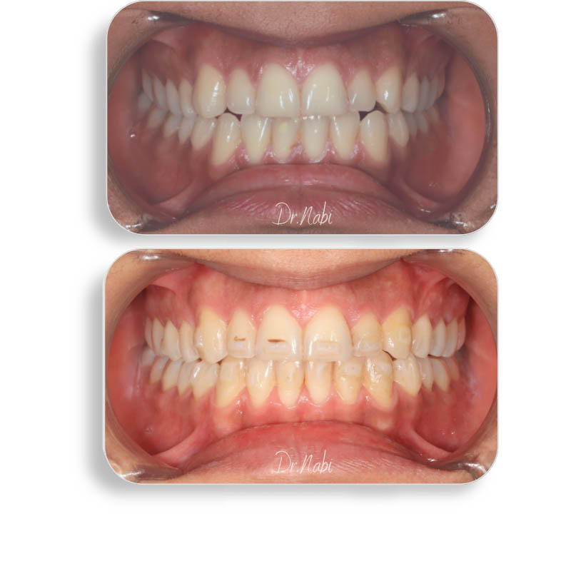 نما داخل دهان بیمار با نامرتبی دندانها واپن بایت خفیف  قبل درمان و نما داخل دهان بعد درمان با ارتودنسی نامرئی توسط دکتر نبی در یک تصویر
