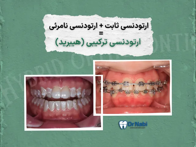 ارتودنسی ترکیبی (هیبرید) چیست؟