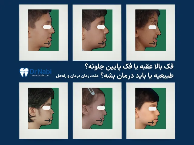 درمان جلو بودن فک پایین و عقب بودن فک بالا در کودکان