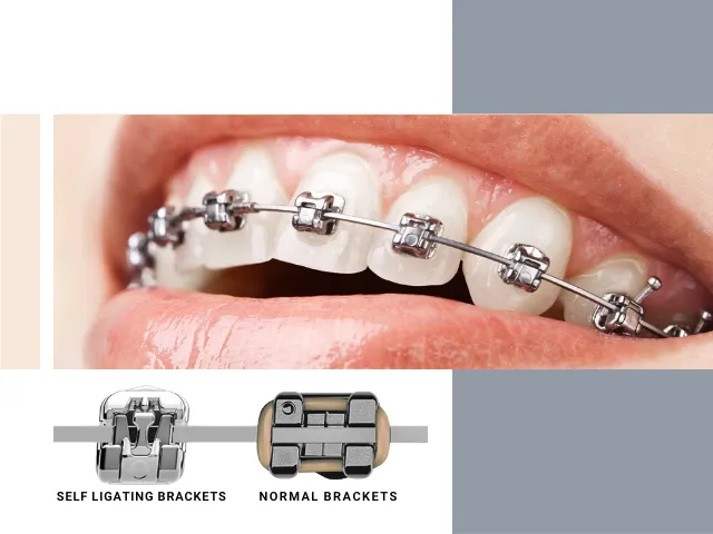 براکت سلف لیگیتینگ در ارتودنسی ثابت چیست و چه تفاوتی با روش معمول دارد؟