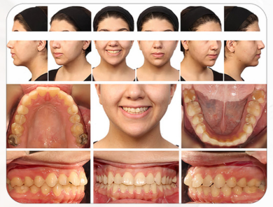 orthodontic photography - فوتوگرافی ارتودنسی قبل درمان فوتوگرافی ارتودنسی صورت و دندانها (Orthodontic Photography) بیمار قبل از درمان