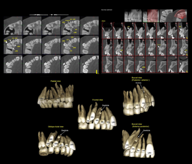 CBCT - قبل درمان تصویر CBCT سه بعدی فکها و دندانها (Cone Beam CT) بیمار قبل از درمان ارتودنسی