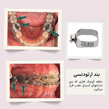 سه نما از بندهای ارتودنسی که روی دندان‌های خلفی قرار می‌گیرند؛ نمای اکلوژن، نمای اکلوزال و تصویر خود بند در یک فریم