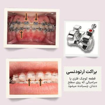 سه تصویر آموزشی از براکت‌های ارتودنسی شامل نمای میدلاین با براکت فلزی، نمای میدلاین با براکت سرامیکی و تصویر جداگانه خود براکت در یک فریم