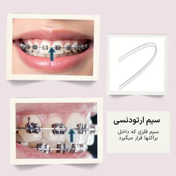 سه تصویر شامل دو نمای داخل دهان با سیم ارتودنسی قرارگرفته داخل براکت‌ها و یک تصویر از خود سیم ارتودنسی
