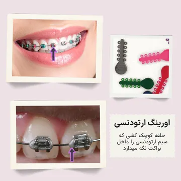 سه تصویر از اورینگ‌های ارتودنسی شامل دو نمای داخل دهان با کش‌های نگهدارنده سیم داخل براکت و یک تصویر از خود اورینگ