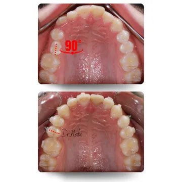 اصلاح روتیشن دندان پرمولر با ارتودنسی شفاف — قبل و بعد دو نمای اکلوزال قبل و بعد درمان ارتودنسی شفاف از روتیشن ۹۰ درجه دندان پرمولر و اصلاح آن