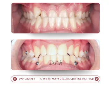 صلاح جایگاه دندانهای فک بالا با ارتودنسی شفاف - قبل و بعد دو نمای داخل دهان از خط میانی قبل و بعد درمان ارتودنسی شفاف برای اصلاح دندانهای جلوی فک بالا که پشت فک پایین قرار داشتند
