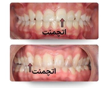 نمای اتچمنتهای ارتودنسی شفاف دو نمای داخل دهان از خط میانی برای نمایش اتچمنتهای ارتودنسی شفاف