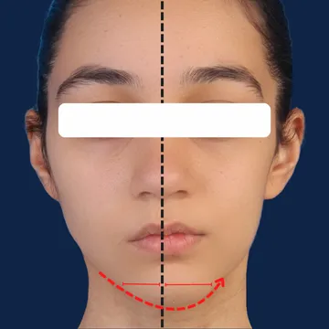 مای روبرو از بیمار با نامتقارنی شدید فک و نامتقارنی صورت قبل از درمان ارتودنسی و جراحی فک
