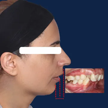 نیمرخ صورت و اکلوژن داخل دهان بیمار با کلاس 2 کیس جراحی فک (Class II) و اورجت زیاد (Overjet) قبل از درمان