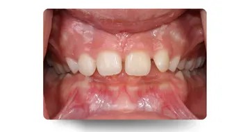 نمای داخل دهان بیمار با دیپ‌بایت (Deep Bite) قبل از درمان ارتودنسی