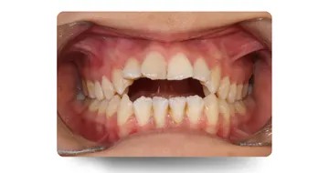 نمای کلینیکی اوپن‌بایت (Open Bite) قدامی قبل از شروع درمان ارتودنسی