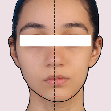 نمای روبرو از بیمار با نامتقارنی شدید فک و نامتقارنی صورت قبل از درمان ارتودنسی