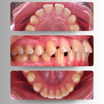 سه نمای اکلوژن بالا، پایین و زاویه اکلوزال از فاصله‌های بین دندانی (Spacing) قبل از درمان ارتودنسی