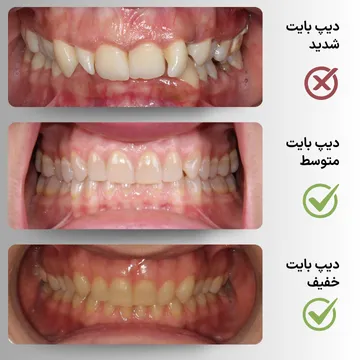 سه نمای داخل دهان از دیپ‌بایت (Deep Bite) خفیف، متوسط و شدید از خط میانی قبل از درمان