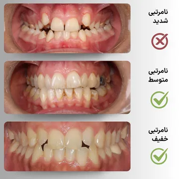 سه نمای داخل دهان از نامرتبی دندانی جزئی، متوسط و شدید (Mild, Moderate, Severe Crowding) از خط میانی قبل از درمان