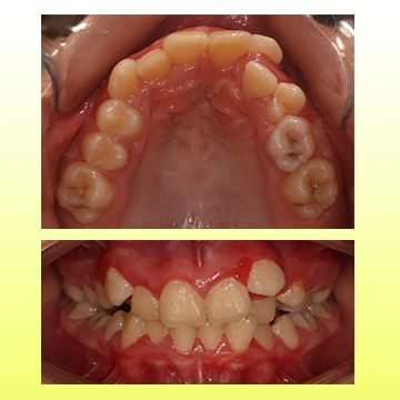 نما اکلوزال بالا و میدلاین دخل دهانی کودک قبل از درمان با کمبود فضای شدید برای رویش دندانهای دائمی در یک تصویر
