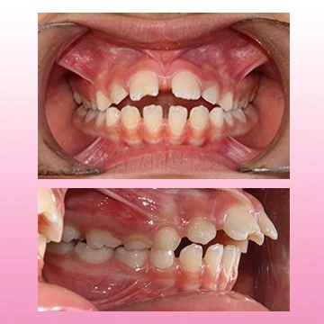 نما میدلاین و نما اکلوژن راست کودک قبل درمان با عادت مکیدن انگشت  که منجر به اپن بایت شده است