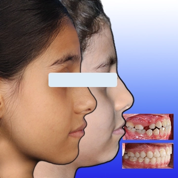 نما نمیرخ صورت کودک قبل و بعد و اکلوژن راست داخل دهانی قبل و بعد درمان - نمونه درمان کلاس 3 با فیس ماسک در یک تصویر