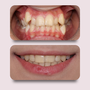 نما میدلاین داخل دهانی قبل درمان و نما کلوزآپ لبخند بعد درمان با ارتودنسی ثابت سلف لیگیتینگ فلزی توسط دکتر نبی در یک تصویر