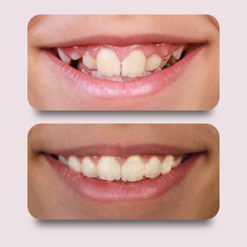 نما کلوزآپ لبخند قبل درمان و نما کلوزآپ لبخند بعد درمان با ارتودنسی ثابت فلزی توسط دکتر نبی در یک تصویر