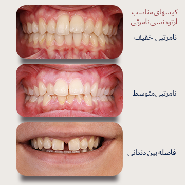 سه نما از میدلاین داخل دهان بیماران دکتر نبی. کیسهای مناسب درمان با ارتودنسی نامرئی. نامرتبی خفیف، نامرتبی متوسط و فاصله بین دندانی قبل درمان در یک تصویر