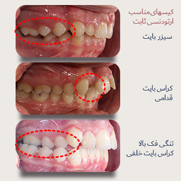 سه نما از اکلوژن راست داخل دهان بیماران دکتر نبی. کیسهای مناسب درمان با ارتودنسی ثابت. سیزربایت، کراس بایت و تنگی فک بالا قبل درمان در یک تصویر