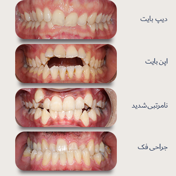 چهار نما از میدلاین داخل دهان بیماران دکتر نبی. کیسهای مناسب درمان با ارتودنسی ثابت. دیپ بایت، اپن بایت، نامرتبی شدید و کیس جراحی فک قبل درمان در یک تصویر