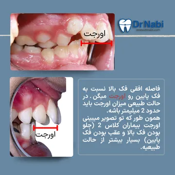 نمای اوکلوژن سمت راست و نمای اوورجت زیاد در کودک با ناهنجاری فکی کلاس 2 در یک تصویر