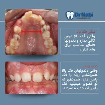 نمای اکلوزال فک بالا با تنگی فک بالا و نمای میدلاین دیپ بایت در کودک