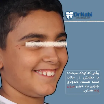 نمای سه رخ کودک با بیرون زدگی دندانهای فک بالا در ناهنجاری کلاس 2