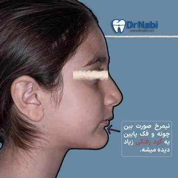 نمای نیمرخ صورت کودک با گودرفتگی واضح بین چانه و فک پایین