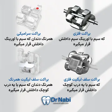 انواع براکت انواع براکت- فلزی، سرامیکی، سلف فلزی، سلف همرنگ در یک تصویر