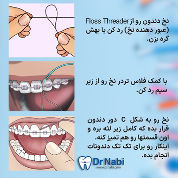 روش استفاده ازنخ دندان در ارتودنسی عبور دادن نخ با فلاس تردر از زیر سیم و تمیز کردن فضای بین دندان ها