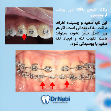 لایه سفید و چسبنده پلاک میکروبی روی دندان دارای ارتودنسی