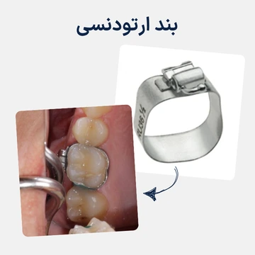 بند ارتودنسی روی دندان آسیاب بند ارتودنسی فلزی نصب شده روی دندان آسیاب برای نگهداری برخی دستگاه های ارتودنسی